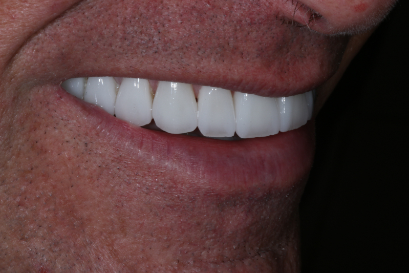 After Porcelain veneers the difference