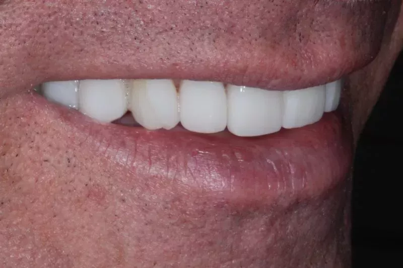 Old veneers replacement