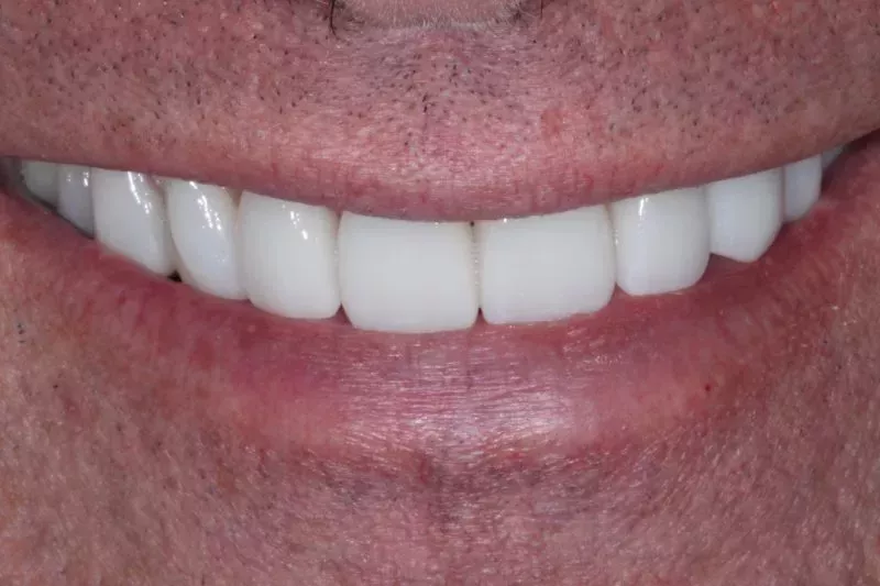 Before Porcelain veneers the difference