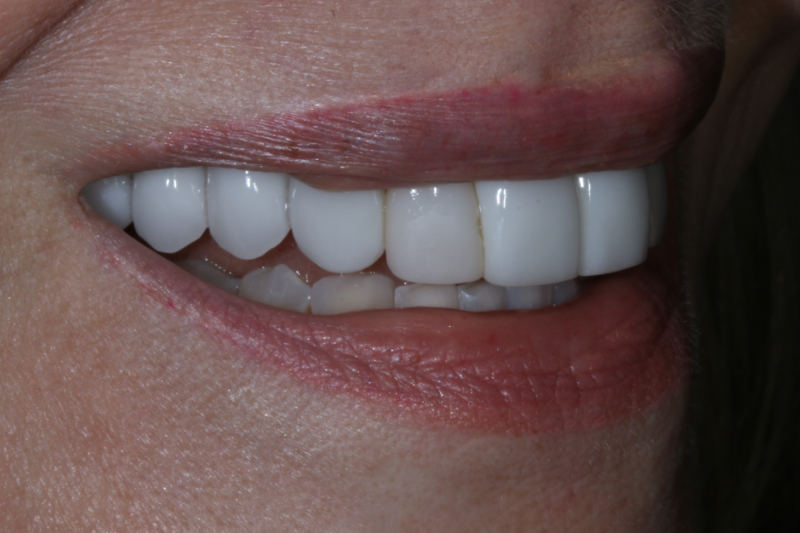 Before Veneers The Knightsbridge Clinic