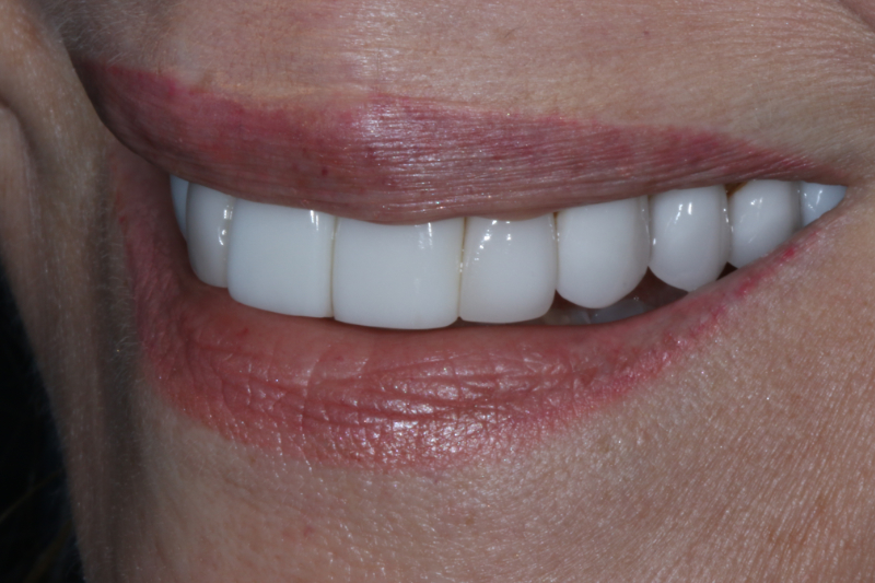 Before Porcelain veneers the difference