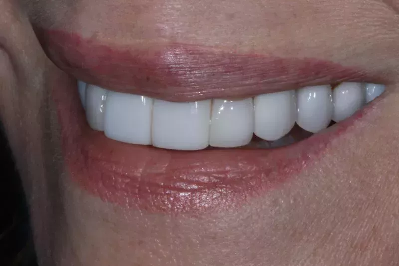 Before Porcelain veneers the difference