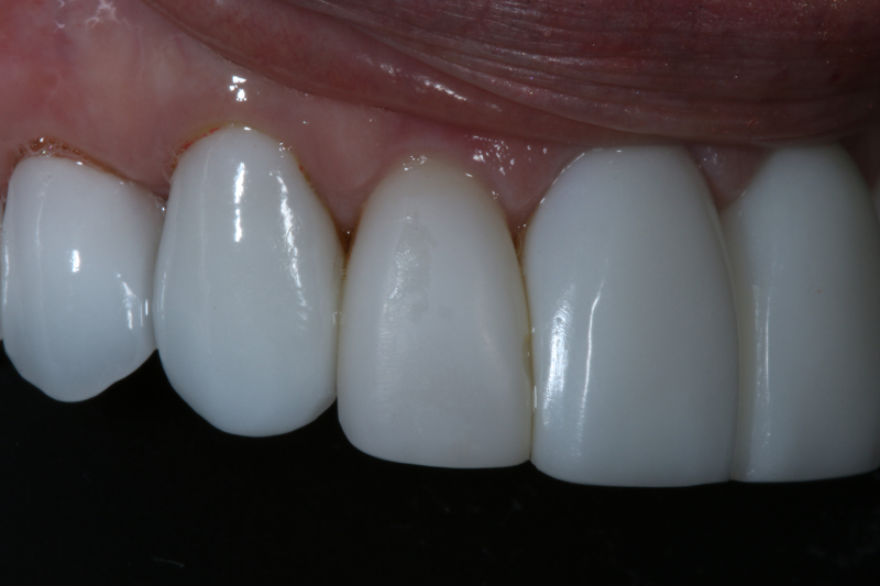 Before Porcelain veneers the difference