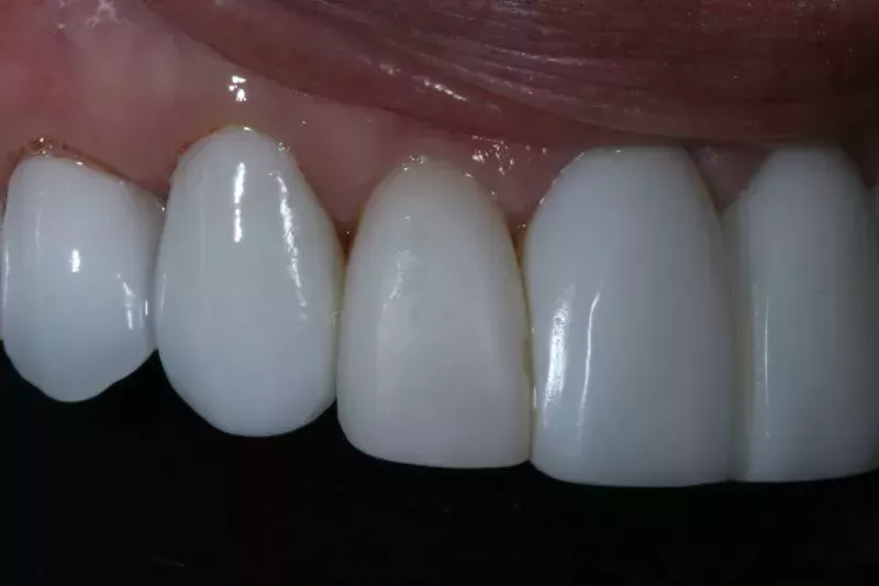 Before Porcelain veneers the difference