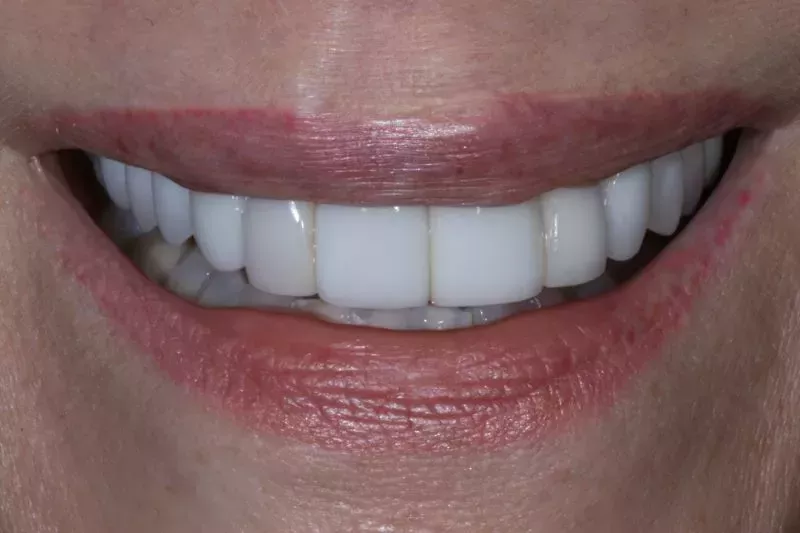 Before Veneers The Knightsbridge Clinic