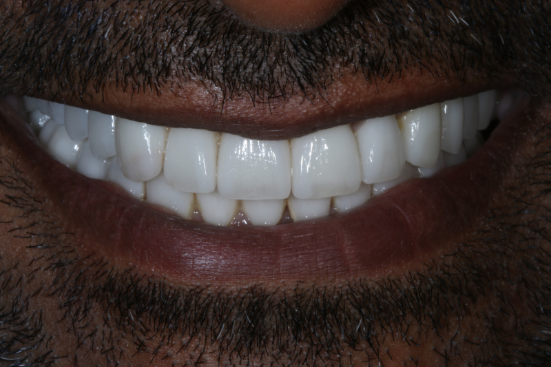 After porcelain veneers