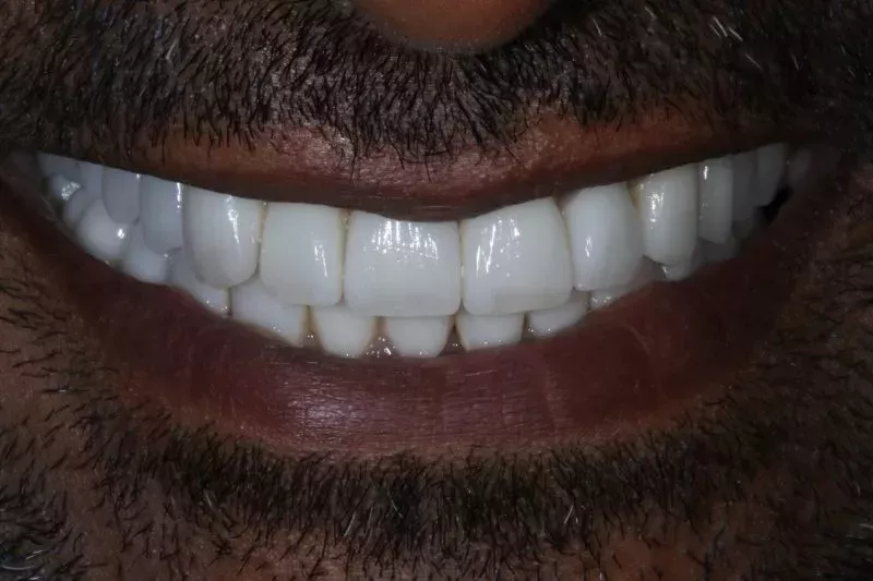 After porcelain veneers