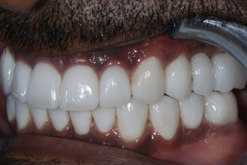 After veneers and implants