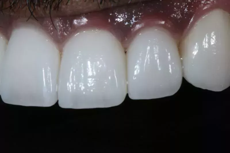 Non-cutting veneers