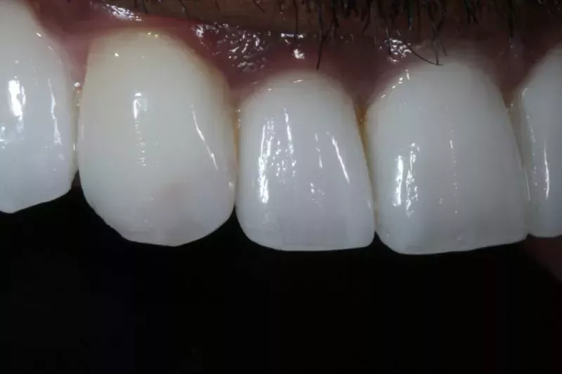 After Porcelain Veneers