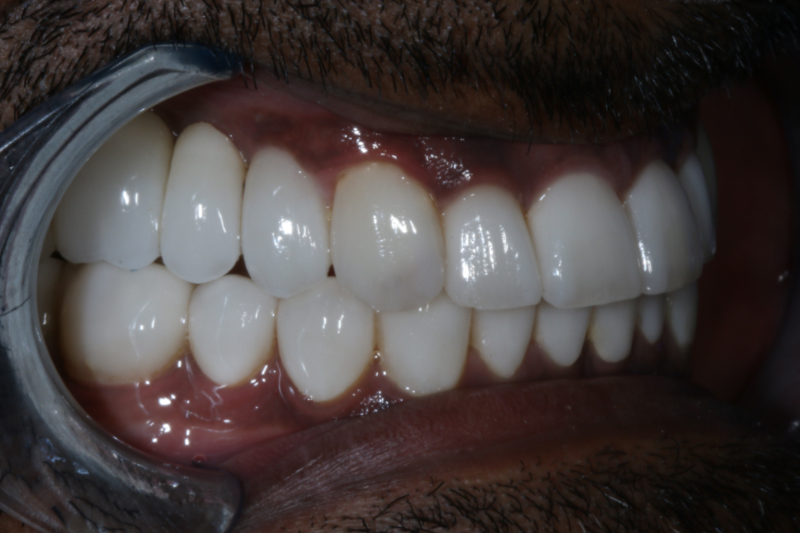 After Veneers The Knightsbridge Clinic