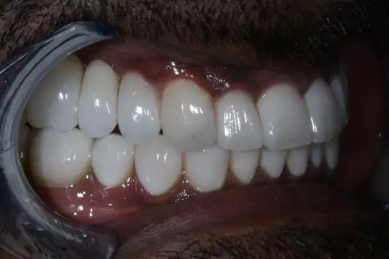 After Veneers The Knightsbridge Clinic