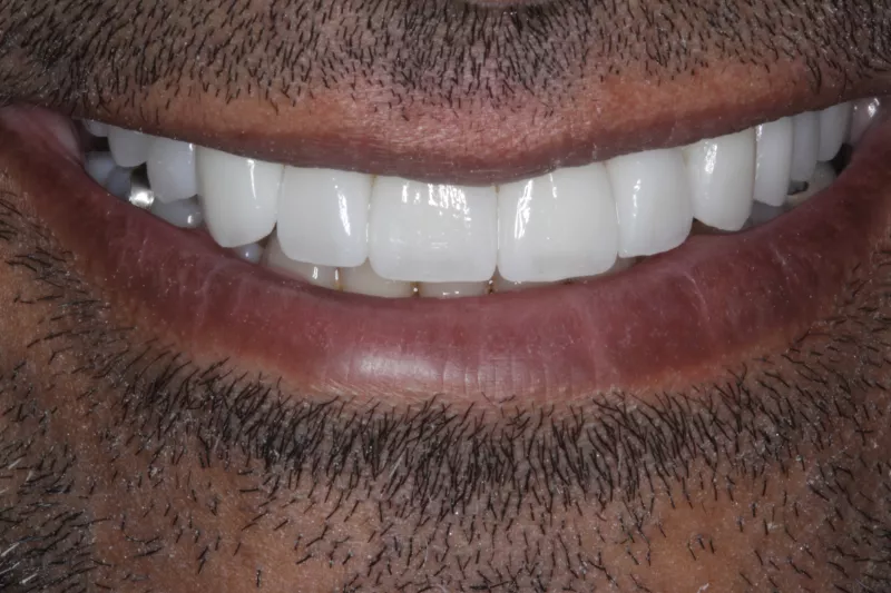 No Damage Veneers Same day loading implants at The Knightsbridge Clinic