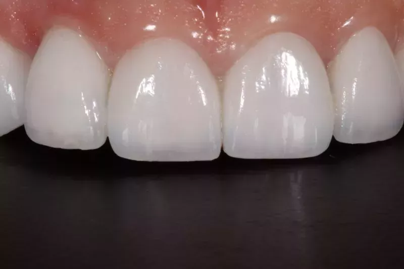 Close up Veneers Turkey Teeth
