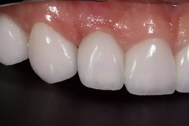 Close up Veneers Close up Veneers