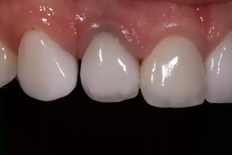 Close up Veneers Close up Veneers