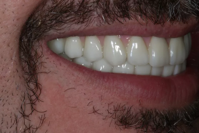 After all on 4 dental implants