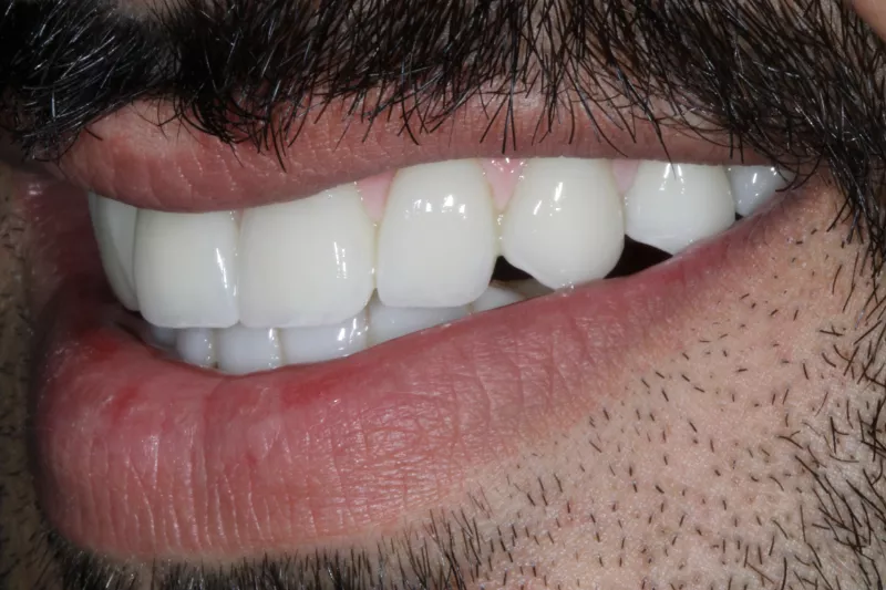 All on 6 dental implants with ceramic crowns
