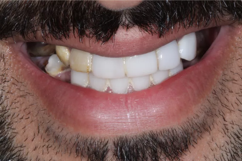 All on 6 upper arch before