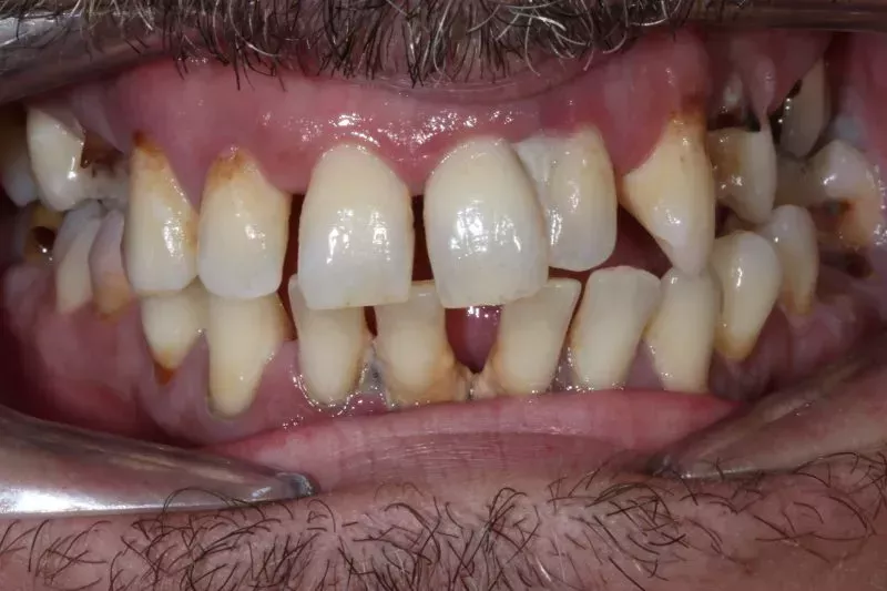 Before full mouth dental implants