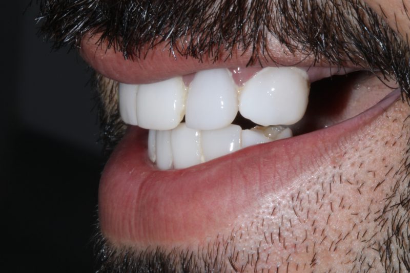 Before full mouth rehabilitation