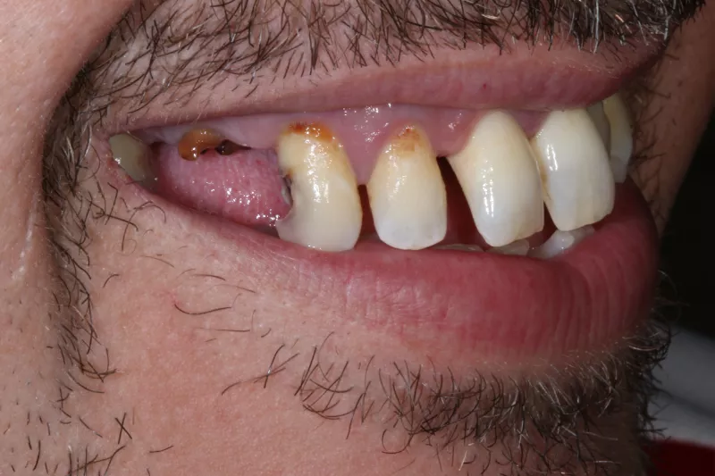 Before full mouth restoration