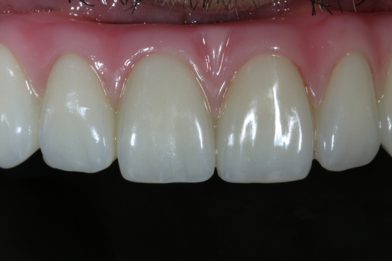 Close up all on 4 dental implants