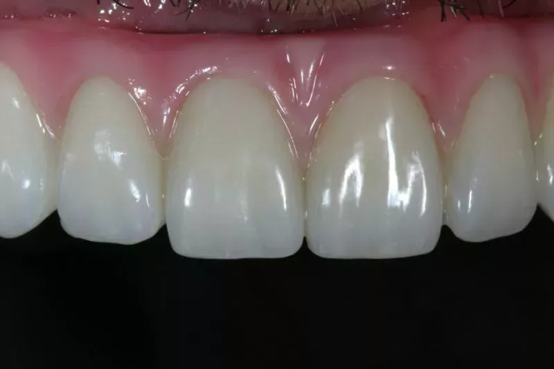 Close up all on 4 dental implants Close up all on 4 dental implants
