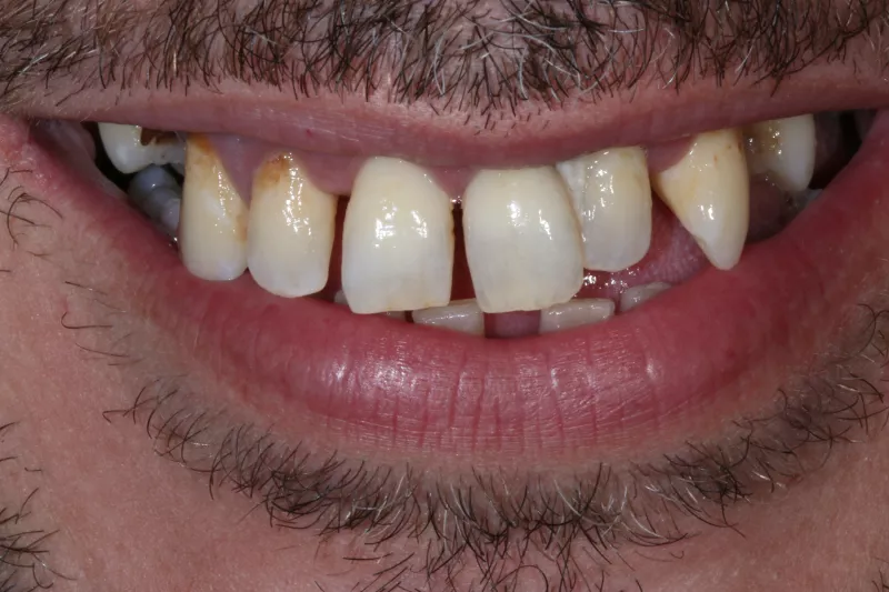 Gum disease pre all on 4 implants