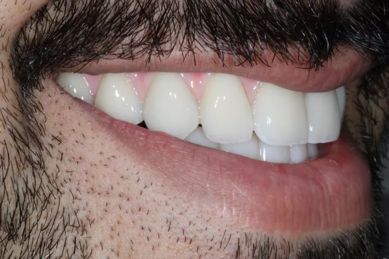 Upper arch all on 6 dental implants