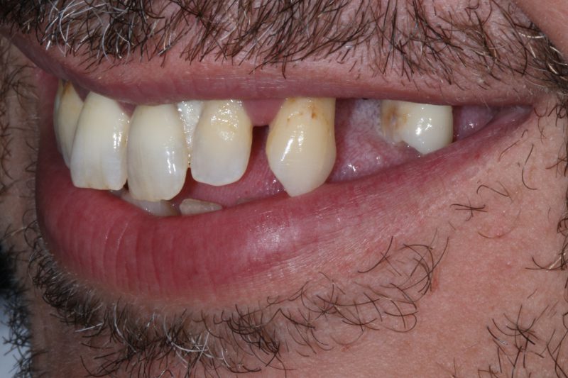 before all on 4 dental implants