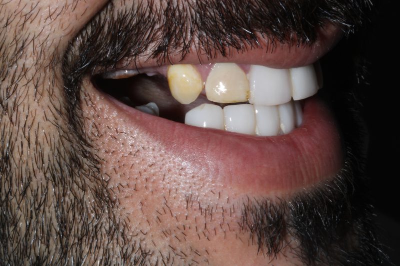 Upper arch all on 6 dental implants