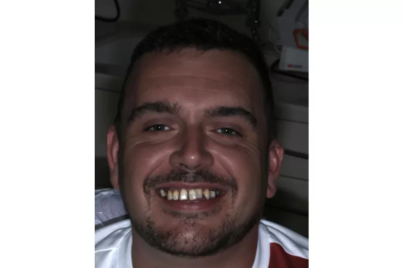 Before all on 4 dental implants