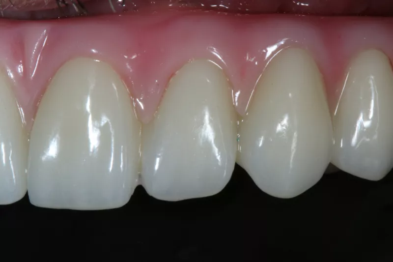 dental implants with ceramic crowns Missing teeth from Gum disease treatment