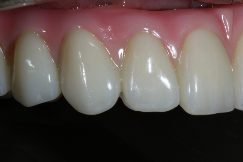 Missing teeth from Gum disease treatment