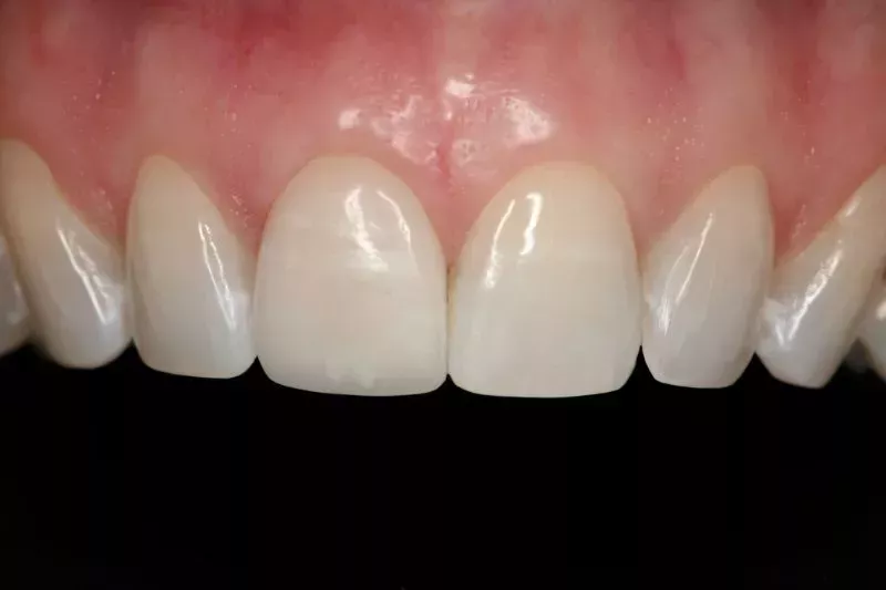 After Veneers The Knightsbridge Clinic