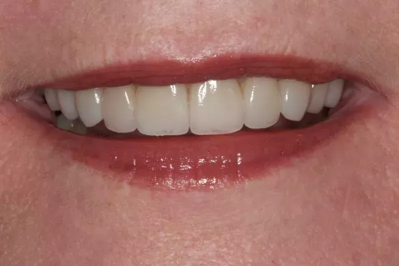 After Veneers The Knightsbridge Clinic