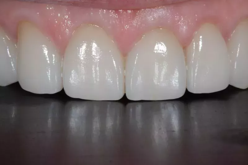 Non cutting porcelain veneers TKC Dental