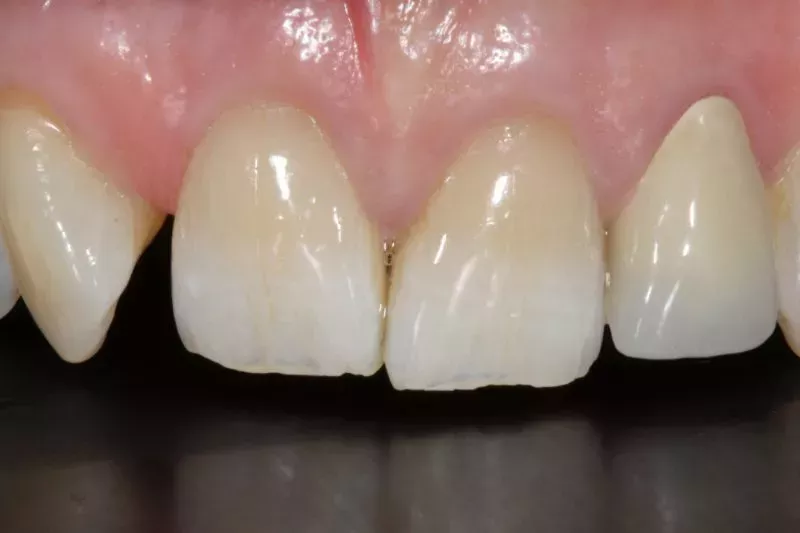 Before Non cutting veneers Knightsbridge