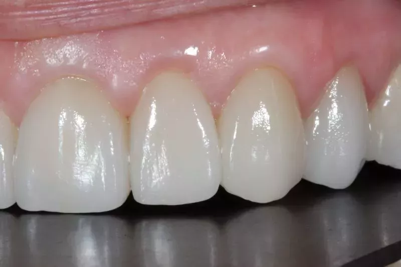 Non cutting veneers Knightsbridge