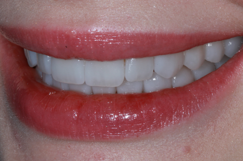 Full mouth non-cutting veneers at the Knightsbridge Clinic