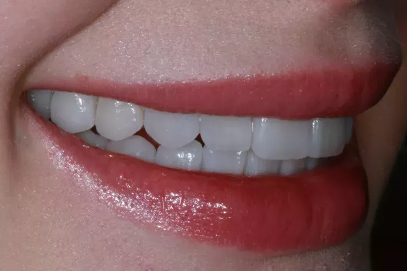 Feldspathic hand-made veneers feldspathic