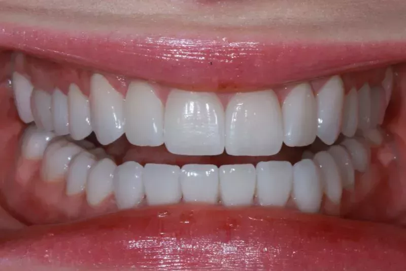 After full mouth porcelain veneers