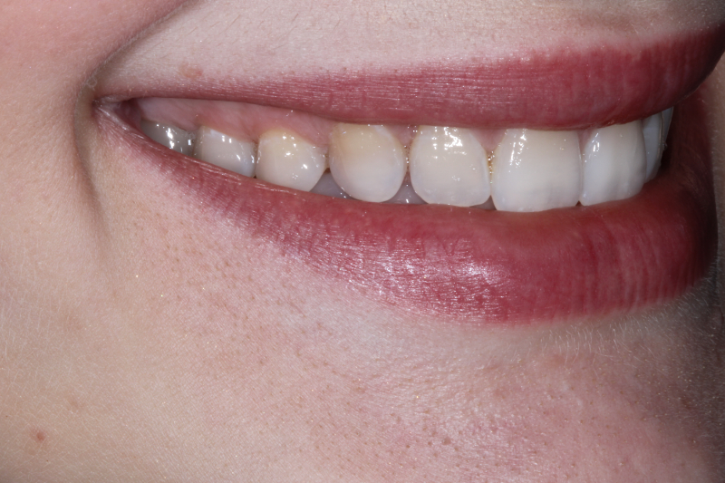 Before Porcelain veneers the difference