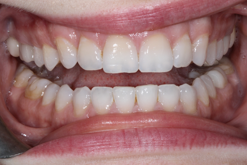 Before dental veneers