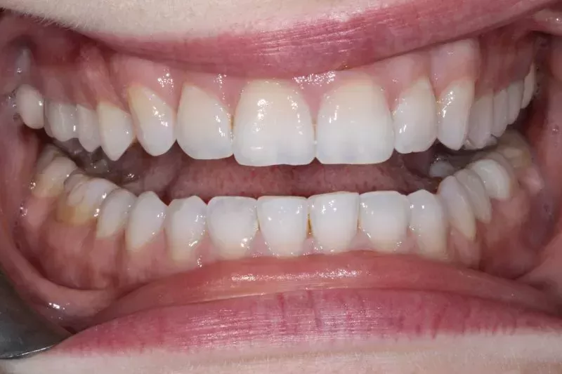 Before dental veneers