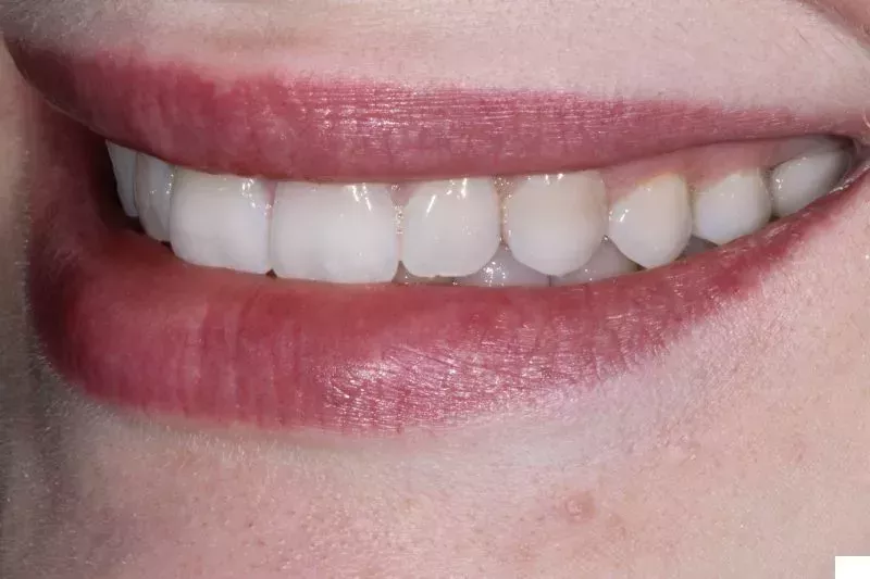 Before Porcelain veneers the difference