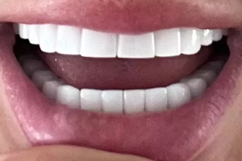 Turkey teeth Turkey Teeth