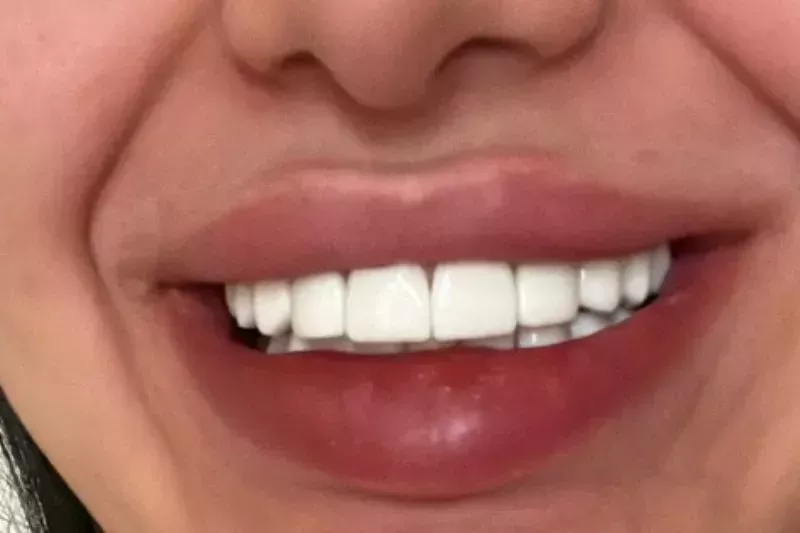 Turkey veneers Turkey Teeth