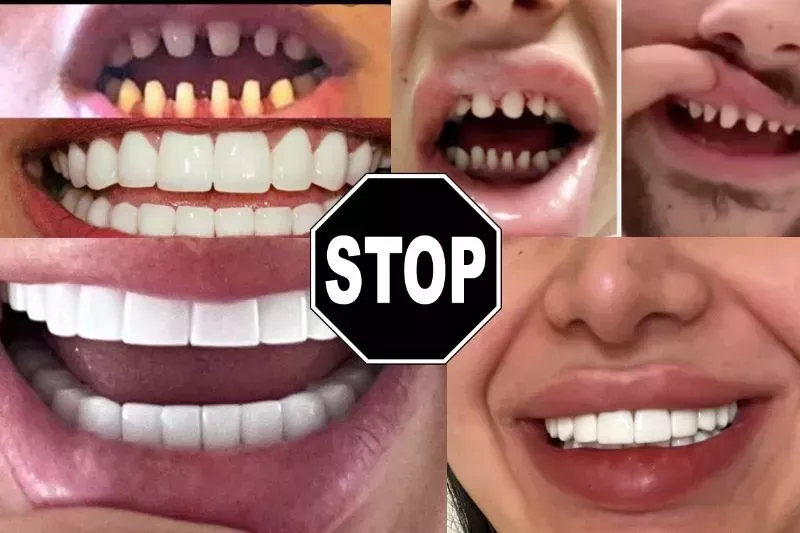 Why shaving teeth is so bad